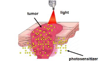 illustration diagram of a tumor on skin, being treated with photosensitizers and red laser diode light