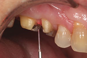 laser diode crown troughing