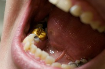 open mouth of a dental patient with crowns