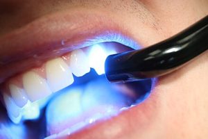 dental lasers UV curing, uv light teeth dentist